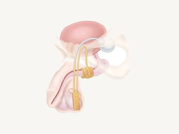 Illustration of an artificial urinary sphincter in place: a cuff around the urethra, tubing to a pump in the scrotum, and a pressure-regulating reservoir behind the abdominal wall.