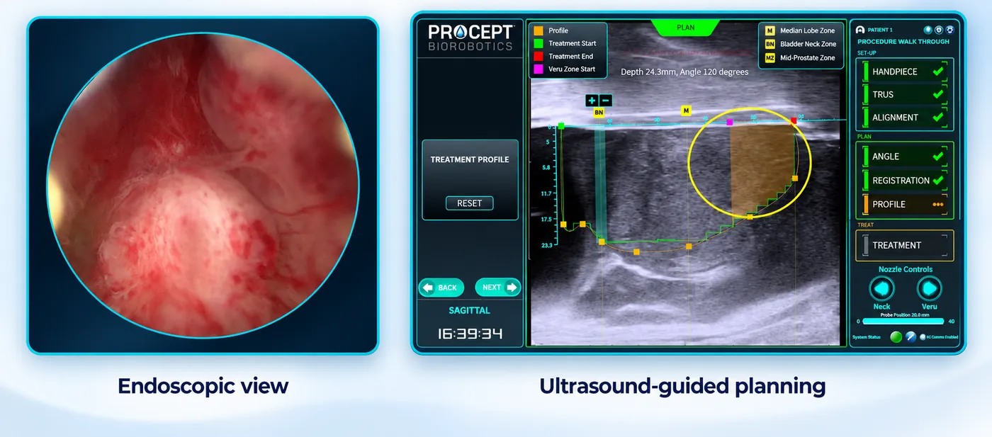Two views side by side. Left, the endoscopic view down the telescope showing the inside of the prostatic urethra. Right, the planning screen: a sagittal ultrasound image of the prostate with the treatment contour drawn on it, depth and angle read-outs, and coloured markers for the treatment start and end and for the bladder neck, mid-prostate and veru zones.